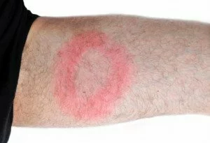 Tick bite CanadianPharmacyMeds.com